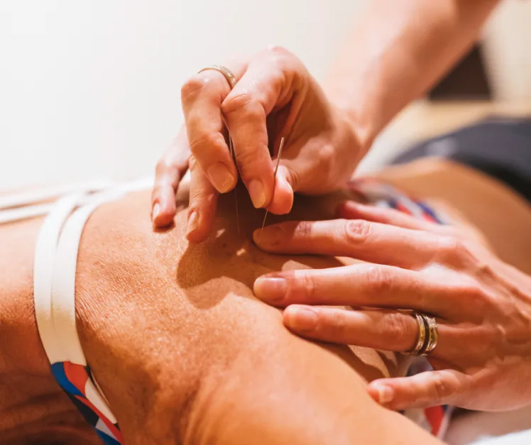 Dry needling